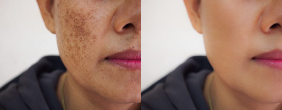 Foto de rosto de paciente mostrando antes e depois do tratamento de melasma